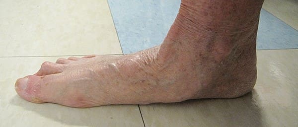 flat-foot